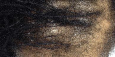 TRACTION ALOPECIA Cayman Islands Hair Loss