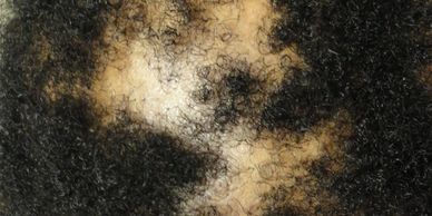 CICATRICIAL ALOPECIA Cayman Islands Hair Loss
