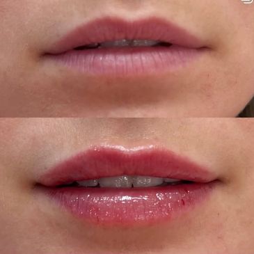 See how subtle, precise lip rejuvenation creates fuller, smoother, and beautifully defined lips.