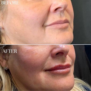 Before and after lip enhancement procedure.
