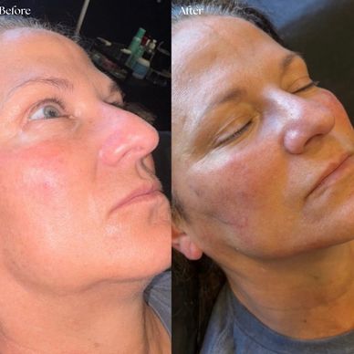 Before and after facial skin treatment showing reduced redness.