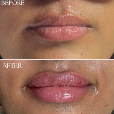 Before and after lip enhancement showing fuller lips.