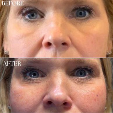 Close-up before and after of a woman's face showing skin changes.