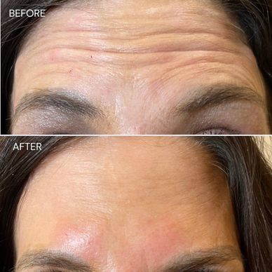 Forehead wrinkles reduced after treatment