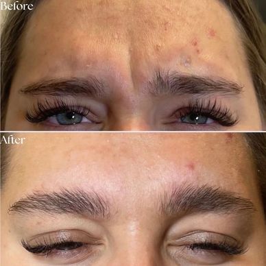 Before and after acne treatment on forehead.