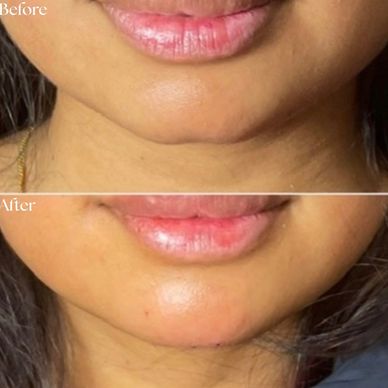 Before and after images of a person's chin and lips.