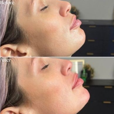 Before and after lip enhancement.