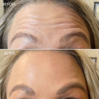 Comparison of forehead before and after treatment to reduce wrinkles.