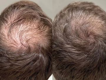 PRP Hair Growth Plasma Injections in Liverpool. Proven hair loss treatment after gastric sleeve.