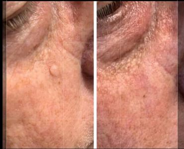 Close-up of facial skin before and after treatment showing reduced skin bumps and improved texture.