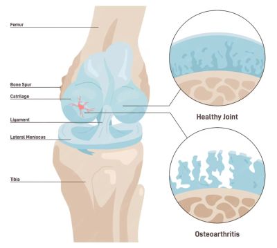 Comparison of healthy joint and osteoarthritis in knee anatomy.