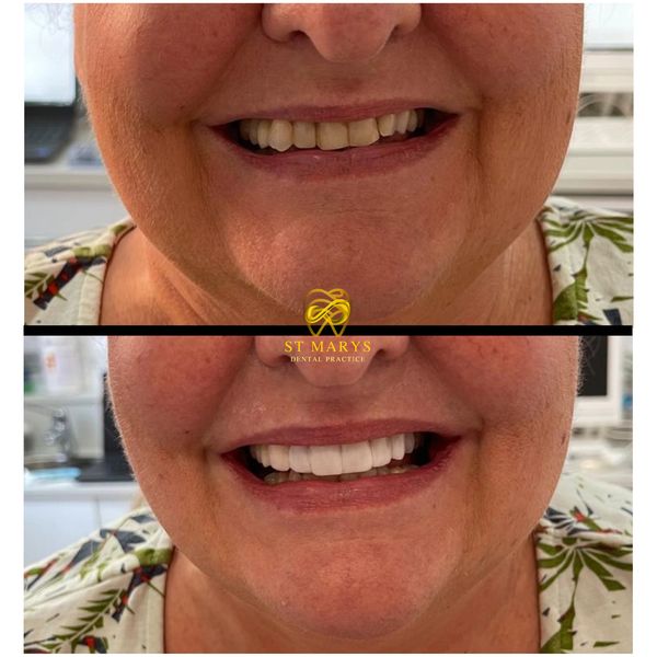 Before and After Transformation Dentistry in Market Drayton.