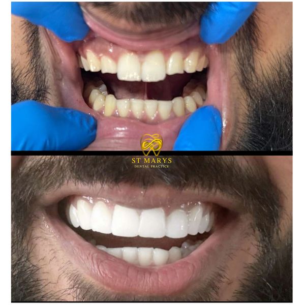 Patient showing his incredible Composite Bonding Transformation at St Mary's Dental Market Drayton