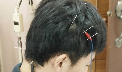 scalp acupuncture头皮针