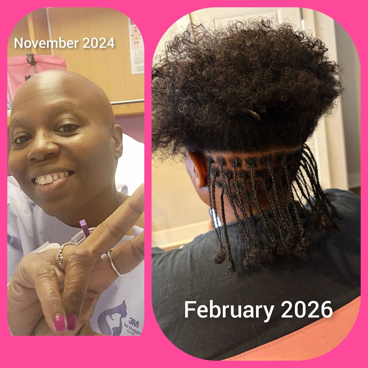 Hair growth progress from bald in 2024 to braided hair in 2026.