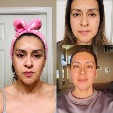 Images of before and after Vaso Mask usage.