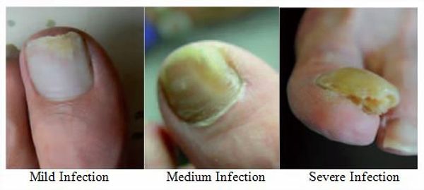 The various stages of a fungal toe infection.