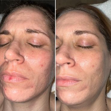 BioRepeel, Chemical peel, acne, facial, SkinCeuticals