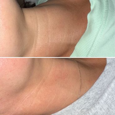 neck lift, microneedling, microneedling rf, neck lines