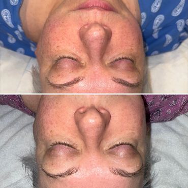 BioRepeel, SkinBetter, skincare, professional skincare