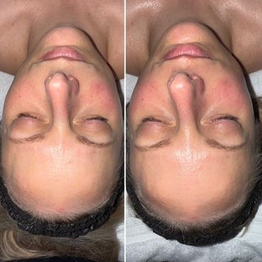HydraFacial, skincare, skin care, facial