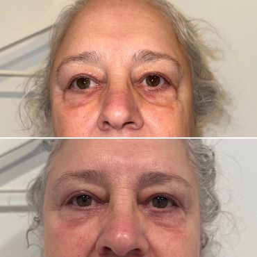 microneedling rf, secret rf, microneedling, eye lift, saggy eyes, puffy eyes