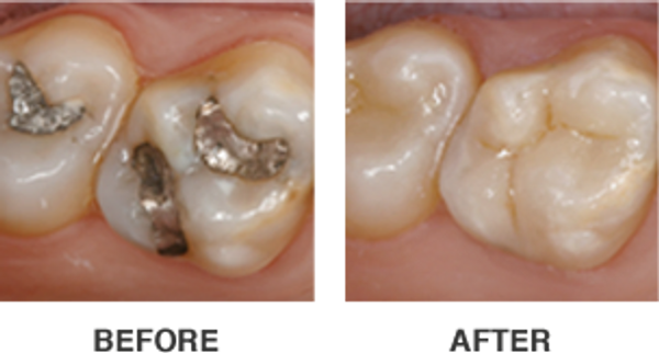 This image shows teeth with failing fillings replaced with a CEREC restoration.