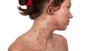 Rosacea, psoriasis, eczema, break out, skin care woman applying MyTalow beef tallow splotches