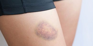 Bruise, heal, skin trauma athletic woman applying MyTalow beef tallow balm to bruise