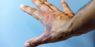 Sun burn, skin care, scar African American hand applying MyTalow beef tallow balm to blister