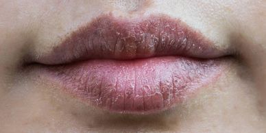 woman with dry chapped lips before applying MyTalow beef tallow balm to lips and dry skin