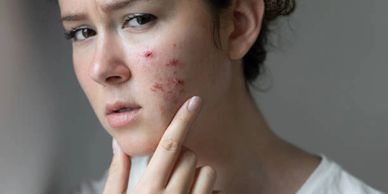 Cystic acne, skin care for sad woman applying MyTalow beef tallow balm to ruptured skin trauma