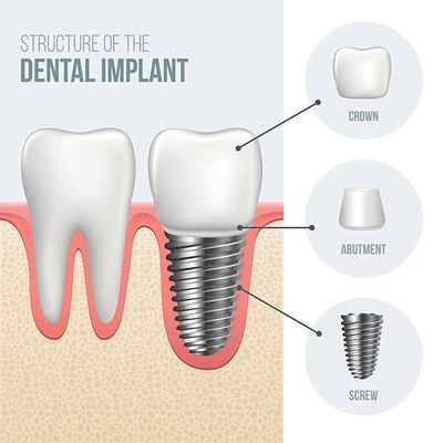 Implant Diagram