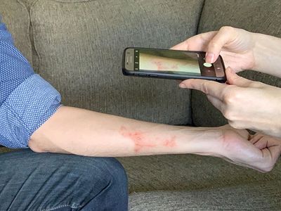 Photograph demonstrating how to correctly photograph a skin condition.