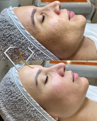 Hydrafacial Cilt Bakımı