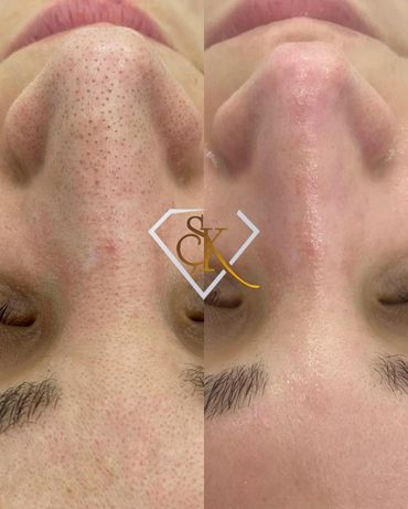 Hydrafacial Cilt Bakımı