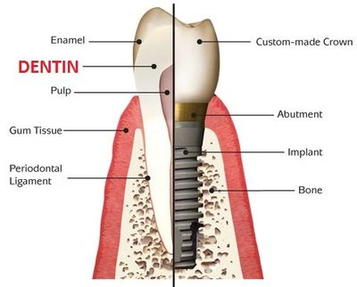 Dental Implants in Wylie, TX, St.paul, TX, Lucas,TX, Parker, TX, Muphy TX. 