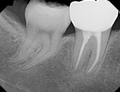 Root canal Treatment Wylie, TX,  dentist Wylie TX, dentist in Wylie, TX, dentist Lucas, TX.