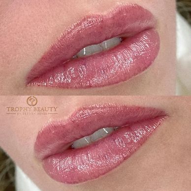 Collagen induction therapy
Collagen 
derma roller
Trophy beauty spa