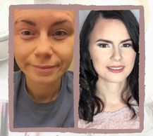 woman with vitiligo #BeautifulBothWaysCampaign