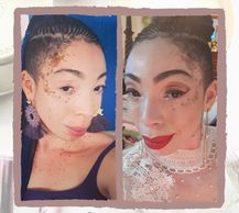 woman with vitiligo #BeautifulBothWaysCampaign