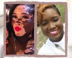 woman with vitiligo #BeautifulBothWaysCampaign