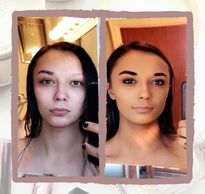 woman with vitiligo #BeautifulBothWaysCampaign