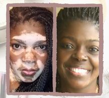 woman with vitiligo #BeautifulBothWaysCampaign
