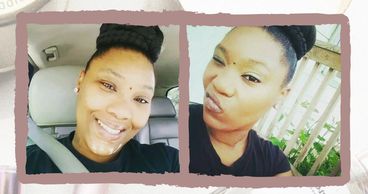 woman with vitiligo #BeautifulBothWaysCampaign