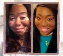 woman with vitiligo #BeautifulBothWaysCampaign