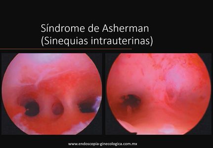 Sd. Asherman, descrito como una patología rara, hoy se sabe que esta enfermedad es subdiagnosticada.