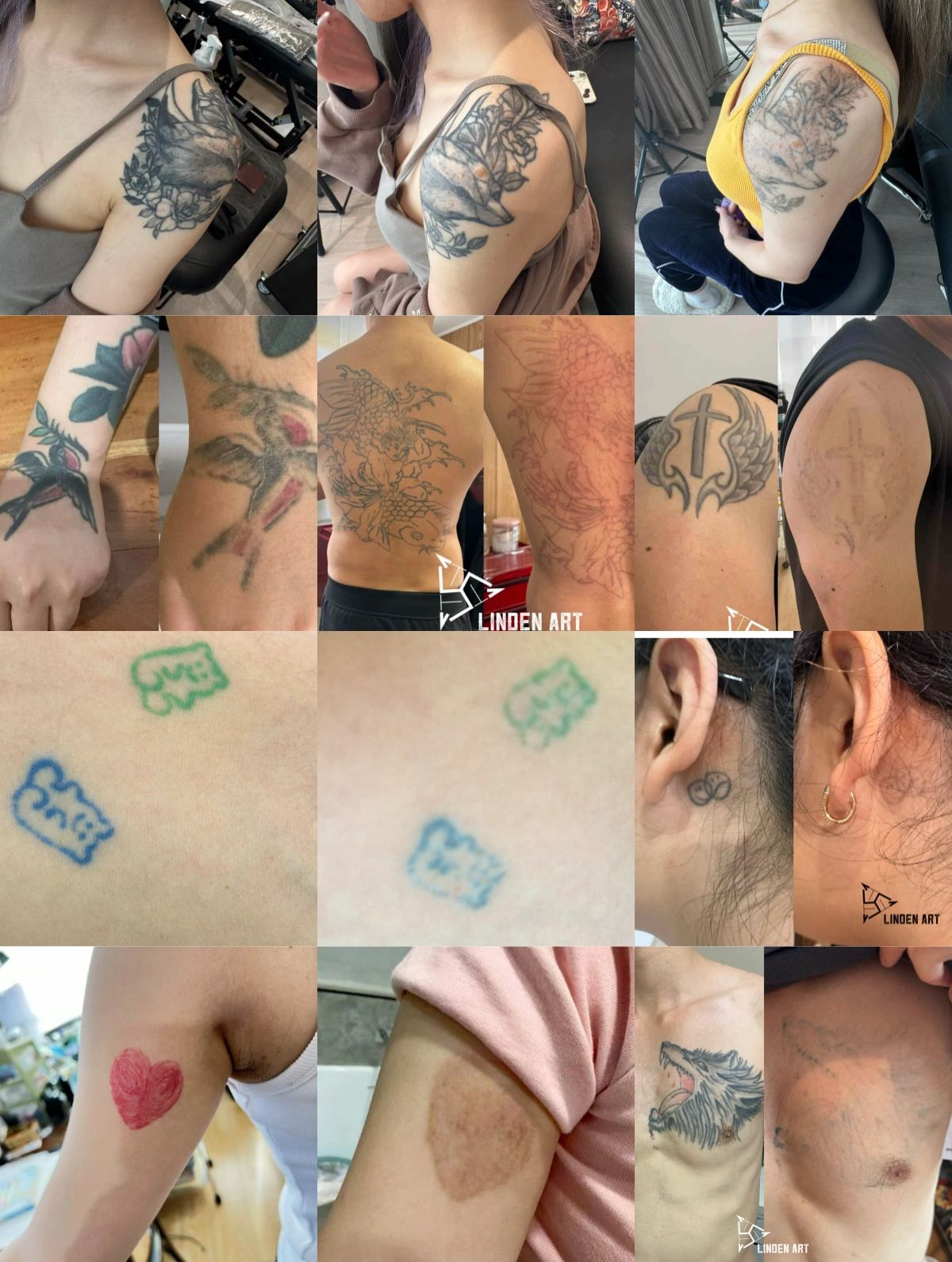 Tattoo removing comparisons