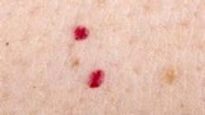 Thermolysis can also be used to treat cherry angiomas