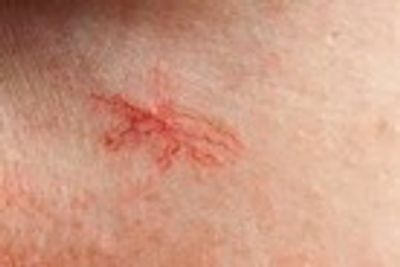 Treatment Process: In thermolysis treatment for spider veins